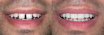 Smile Gallery - Estrella Dental, Elgin Dentist
