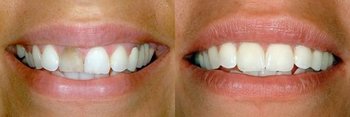 Smile Gallery - Estrella Dental, Elgin Dentist