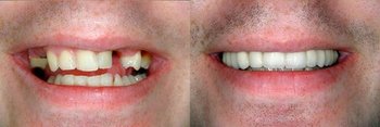 Smile Gallery - Estrella Dental, Elgin Dentist