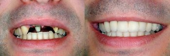 Smile Gallery - Estrella Dental, Elgin Dentist