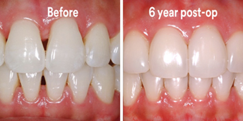 BioClear Diastema Closure and Black Triangle Closure  - Estrella Dental, Elgin Dentist