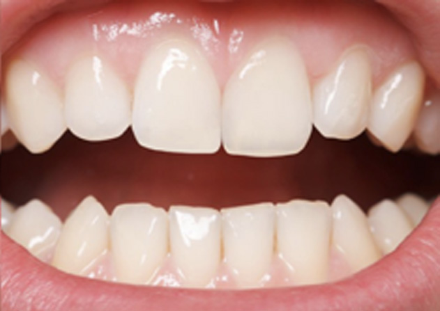 Cosmetic Bonding  - Estrella Dental, Elgin Dentist