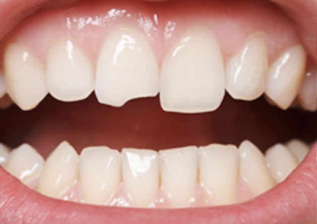 Cosmetic Bonding  - Estrella Dental, Elgin Dentist