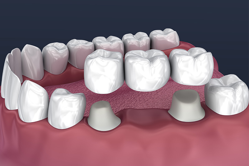 Crowns and Bridges, Inlays and Onlays  - Estrella Dental, Elgin Dentist