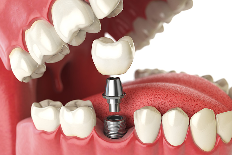 Dental Implants - Estrella Dental, Elgin Dentist