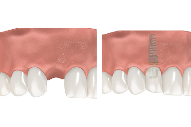 Dental Implants - Estrella Dental, Elgin Dentist