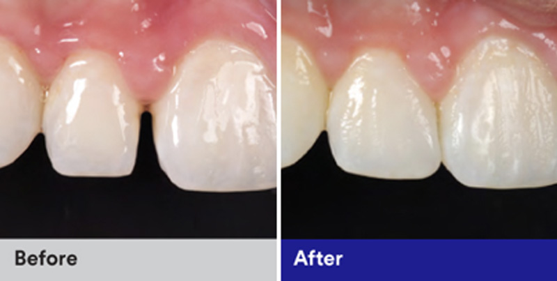 BioClear Diastema Closure and Black Triangle Closure  - Estrella Dental, Elgin Dentist