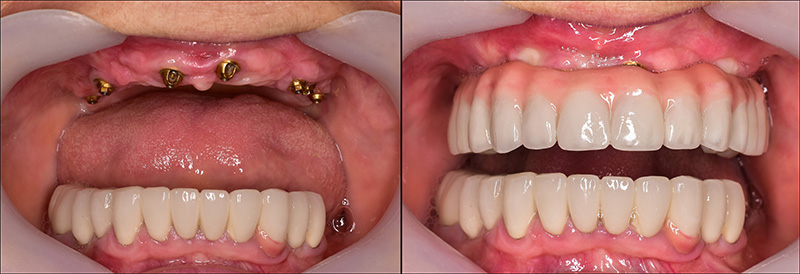 Implant Overdentures and Fixed All-On-X Treatment  - Estrella Dental, Elgin Dentist