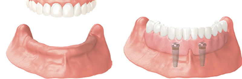 Implant Overdentures and Fixed All-On-X Treatment  - Estrella Dental, Elgin Dentist