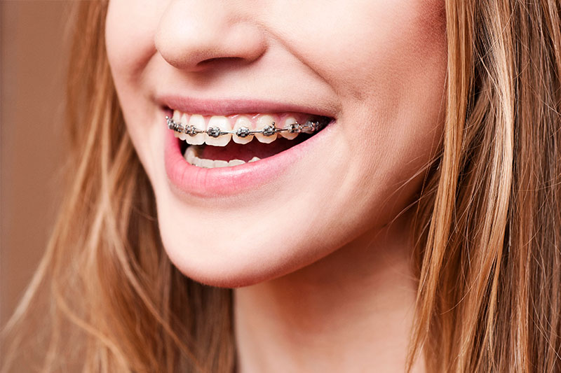Orthodontics - Estrella Dental, Elgin Dentist