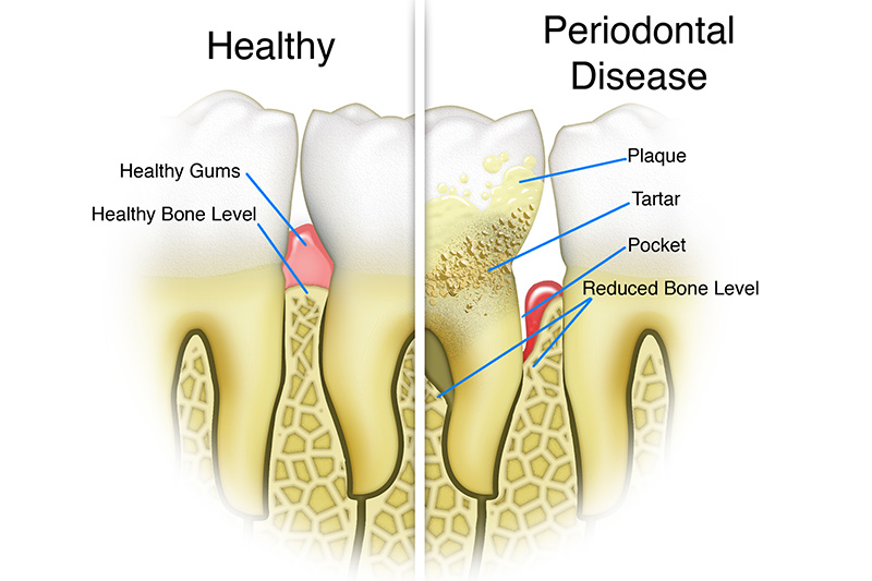 Scaling & Root Planings (Deep Cleanings)  - Estrella Dental, Elgin Dentist