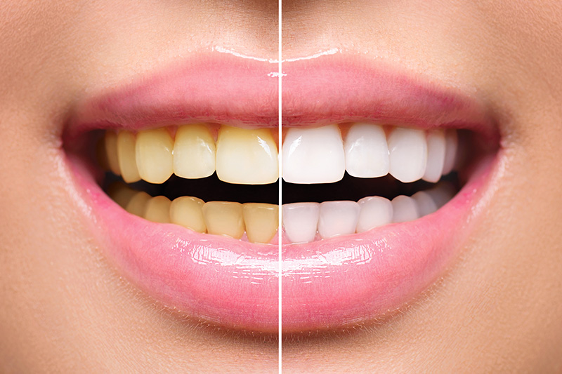 Teeth Whitening - Estrella Dental, Elgin Dentist