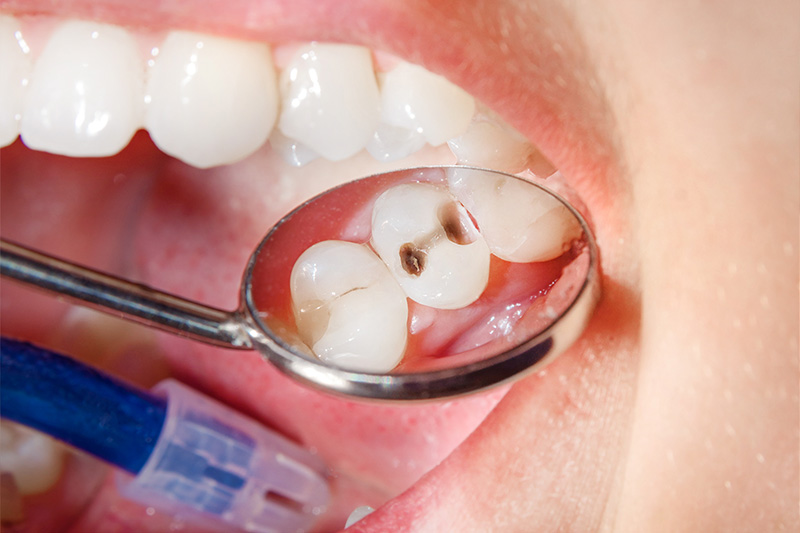 Tooth Colored Composite Fillings  - Estrella Dental, Elgin Dentist