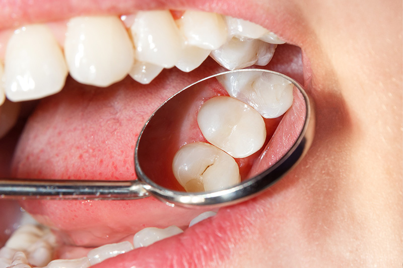 Tooth Colored Composite Fillings  - Estrella Dental, Elgin Dentist