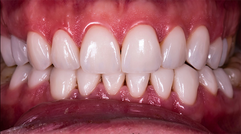 Veneers  - Estrella Dental, Elgin Dentist