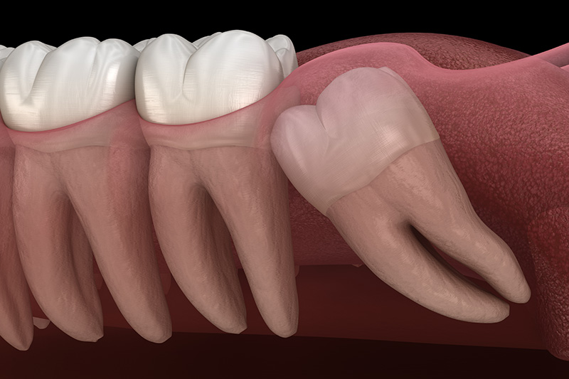 Wisdom Teeth Extractions (with Sedation)  - Estrella Dental, Elgin Dentist